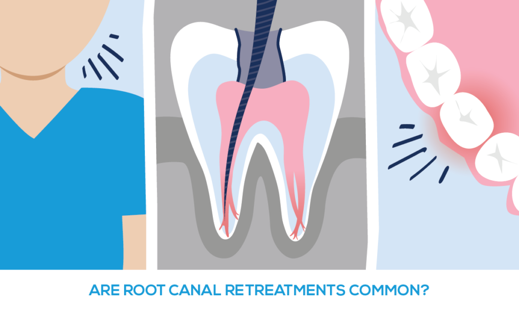 Root Canal Treatment Portland OR - Endodontics