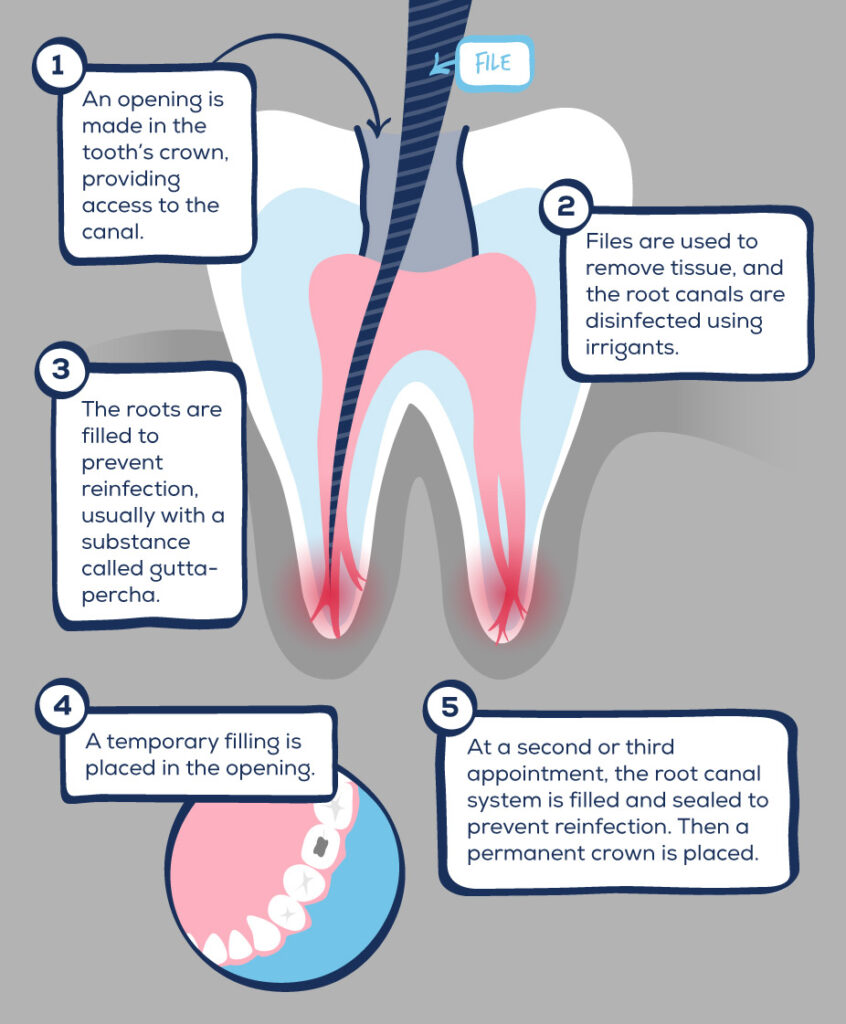 Root Canals In Pensacola FL