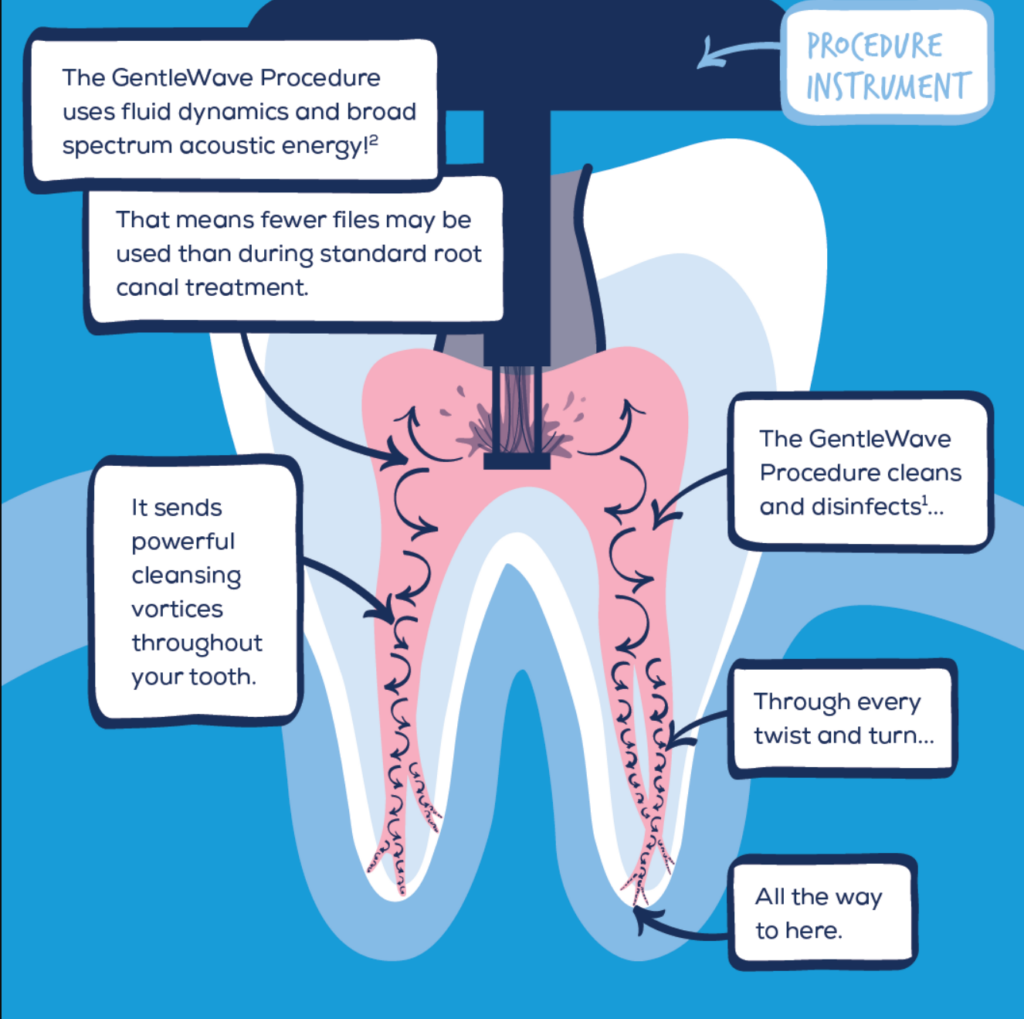 Root Canal Treatment: Meaning and Process